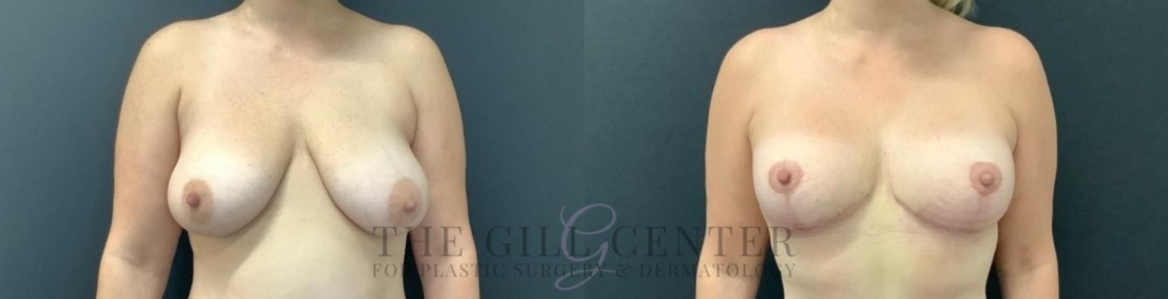Breast Lift Case 747 Before & After Front | The Woodlands, TX | The Gill Center for Plastic Surgery and Dermatology
