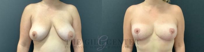 Breast Lift Case 747 Before & After Front | The Woodlands, TX | The Gill Center for Plastic Surgery and Dermatology