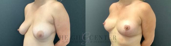 Breast Lift Case 747 Before & After Left Oblique | The Woodlands, TX | The Gill Center for Plastic Surgery and Dermatology