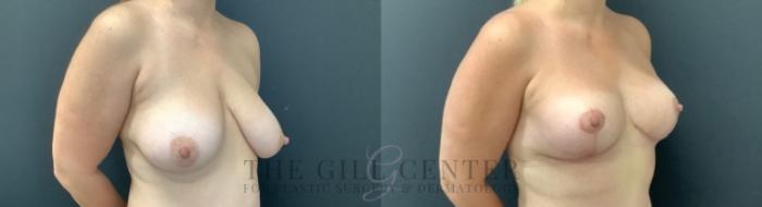 Breast Lift Case 747 Before & After Right Oblique | The Woodlands, TX | The Gill Center for Plastic Surgery and Dermatology