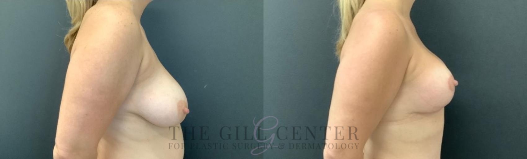 Breast Lift Case 747 Before & After Right Side | The Woodlands, TX | The Gill Center for Plastic Surgery and Dermatology