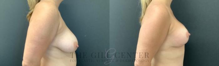 Breast Lift Case 747 Before & After Right Side | The Woodlands, TX | The Gill Center for Plastic Surgery and Dermatology