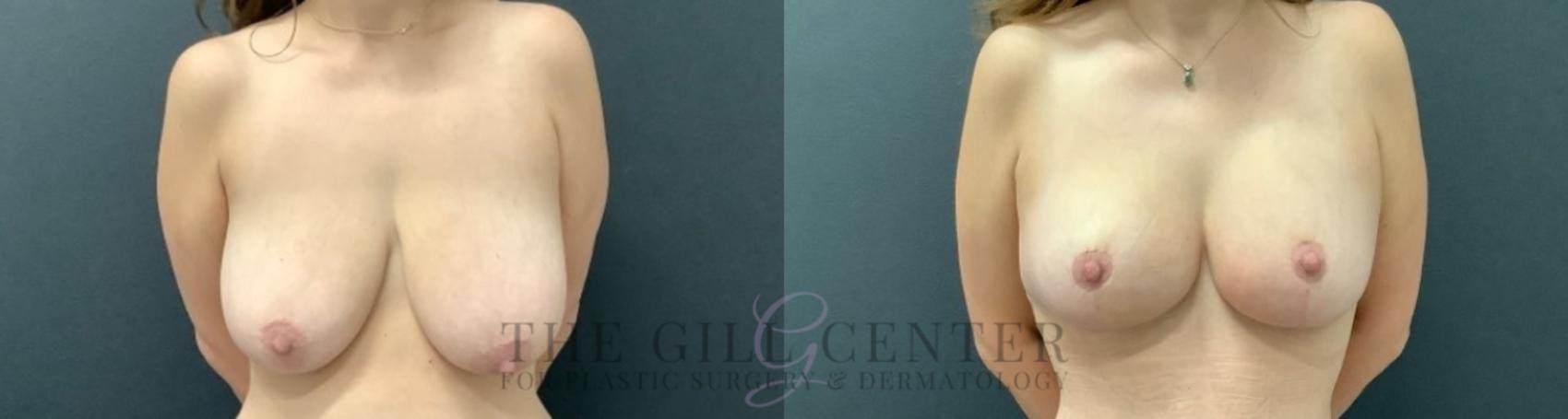 Breast Lift Case 748 Before & After Front | The Woodlands, TX | The Gill Center for Plastic Surgery and Dermatology