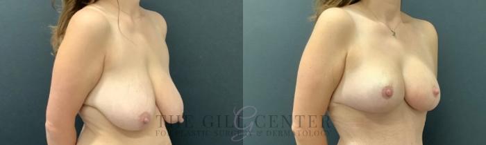 Breast Lift Case 748 Before & After Right Oblique | The Woodlands, TX | The Gill Center for Plastic Surgery and Dermatology