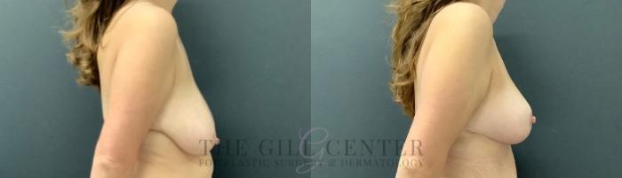 Breast Lift Case 748 Before & After Right Side | The Woodlands, TX | The Gill Center for Plastic Surgery and Dermatology