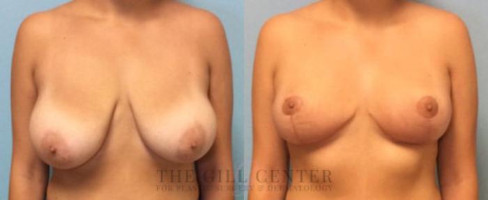 Breast Lift Case 75 Before & After Front | The Woodlands, TX | The Gill Center for Plastic Surgery and Dermatology