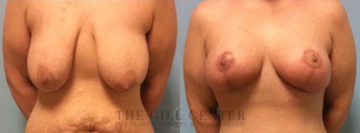 Breast Lift Case 77 Before & After Front | The Woodlands, TX | The Gill Center for Plastic Surgery and Dermatology