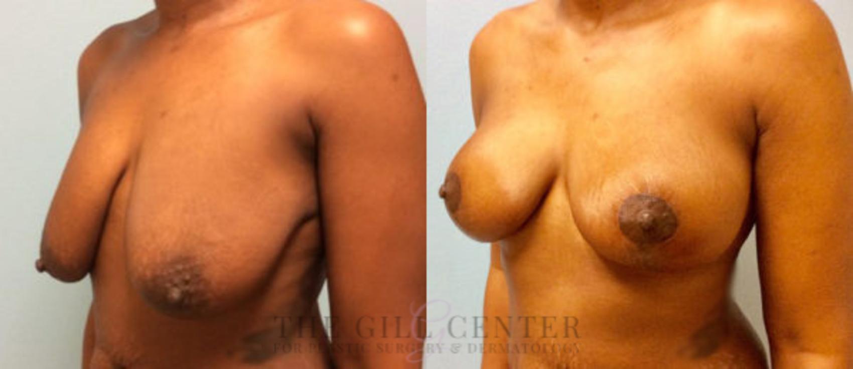 Breast Lift Case 78 Before & After Left Oblique | The Woodlands, TX | The Gill Center for Plastic Surgery and Dermatology