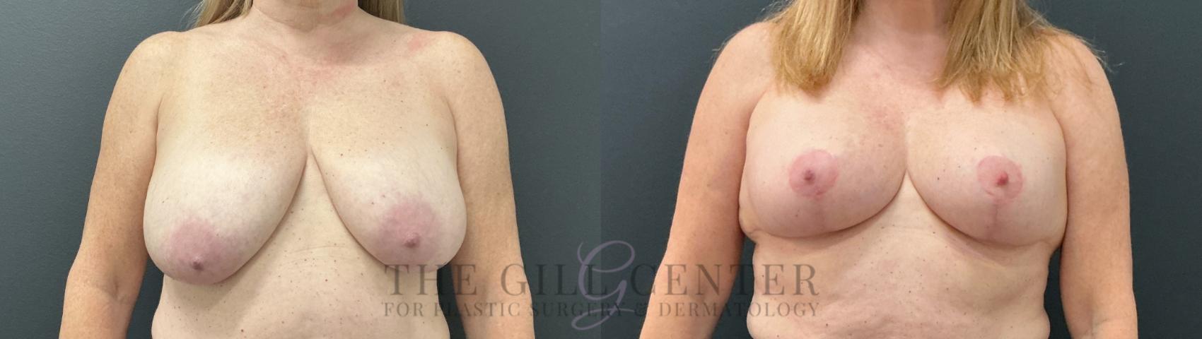 Breast Lift Case 788 Before & After Front | The Woodlands, TX | The Gill Center for Plastic Surgery and Dermatology