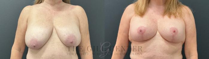 Breast Lift Case 788 Before & After Front | The Woodlands, TX | The Gill Center for Plastic Surgery and Dermatology