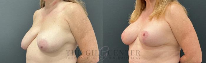 Breast Lift Case 788 Before & After Left Oblique | The Woodlands, TX | The Gill Center for Plastic Surgery and Dermatology