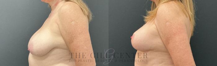 Breast Lift Case 788 Before & After Left Side | The Woodlands, TX | The Gill Center for Plastic Surgery and Dermatology