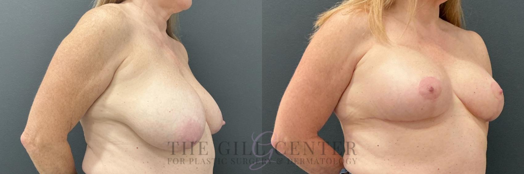 Breast Lift Case 788 Before & After Right Oblique | The Woodlands, TX | The Gill Center for Plastic Surgery and Dermatology
