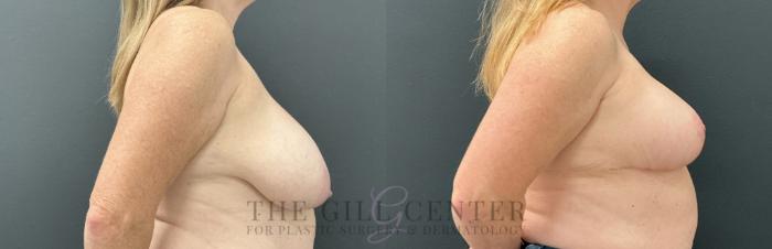 Breast Lift Case 788 Before & After Right Side | The Woodlands, TX | The Gill Center for Plastic Surgery and Dermatology