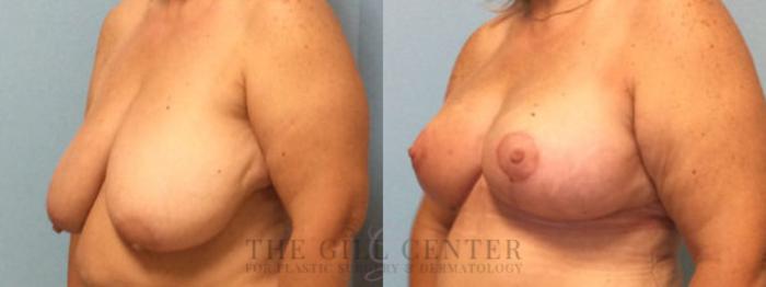 Breast Lift Case 79 Before & After Left Oblique | The Woodlands, TX | The Gill Center for Plastic Surgery and Dermatology