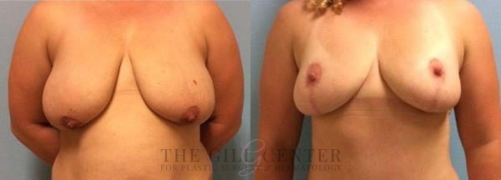 Breast Lift Case 80 Before & After Front | The Woodlands, TX | The Gill Center for Plastic Surgery and Dermatology