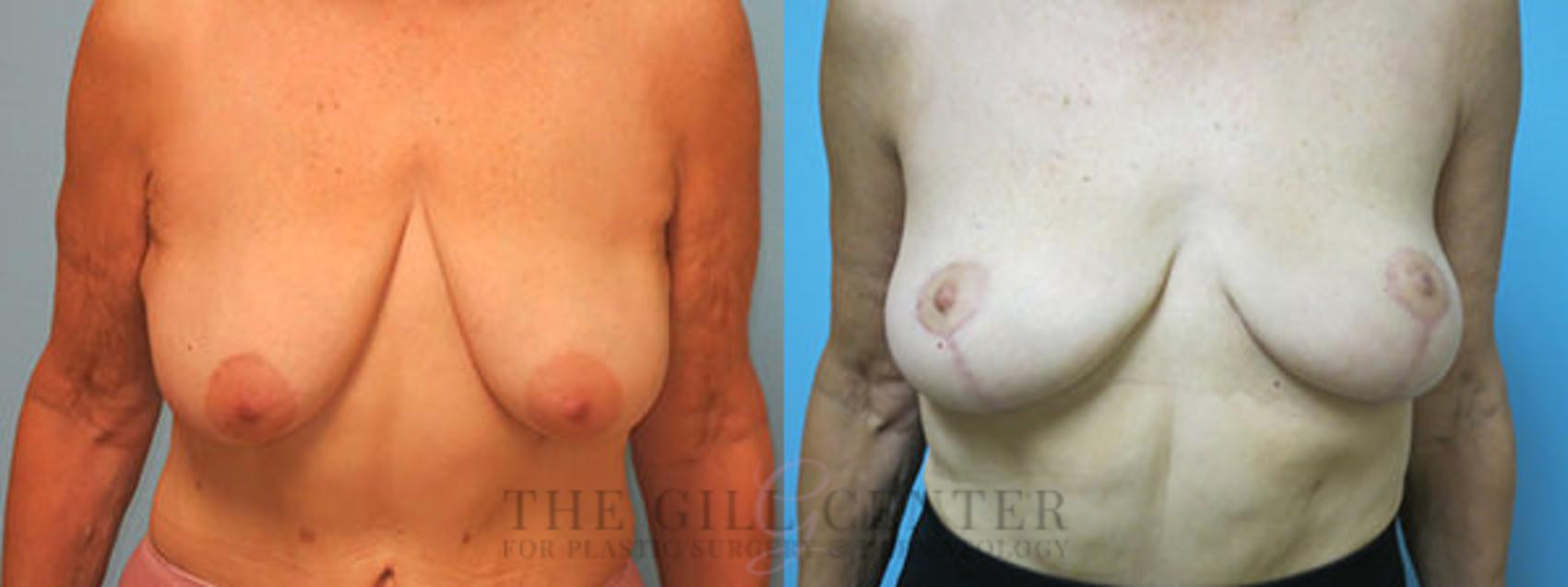 Breast Lift Case 81 Before & After Front | The Woodlands, TX | The Gill Center for Plastic Surgery and Dermatology