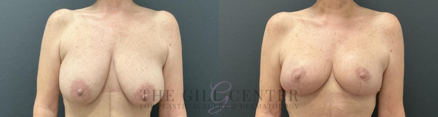 Breast Lift Case 814 Before & After Front | The Woodlands, TX | The Gill Center for Plastic Surgery and Dermatology