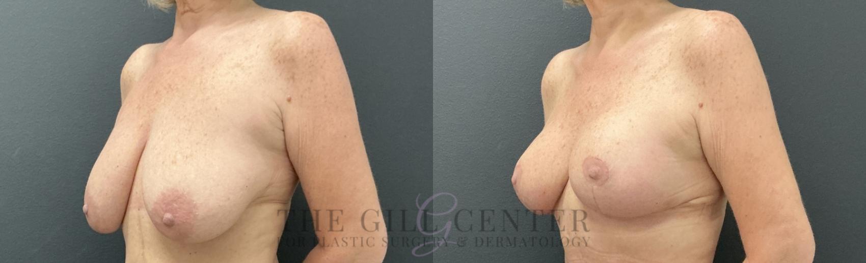 Breast Lift Case 814 Before & After Left Oblique | The Woodlands, TX | The Gill Center for Plastic Surgery and Dermatology