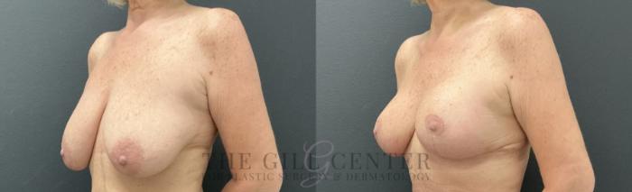 Breast Lift Case 814 Before & After Left Oblique | The Woodlands, TX | The Gill Center for Plastic Surgery and Dermatology