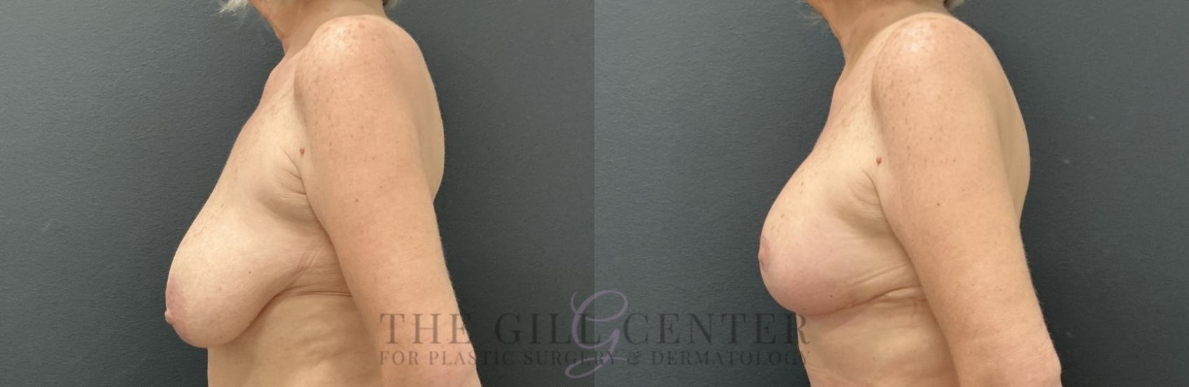 Breast Lift Case 814 Before & After Left Side | The Woodlands, TX | The Gill Center for Plastic Surgery and Dermatology