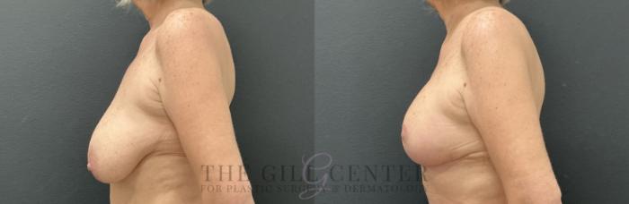Breast Lift Case 814 Before & After Left Side | The Woodlands, TX | The Gill Center for Plastic Surgery and Dermatology