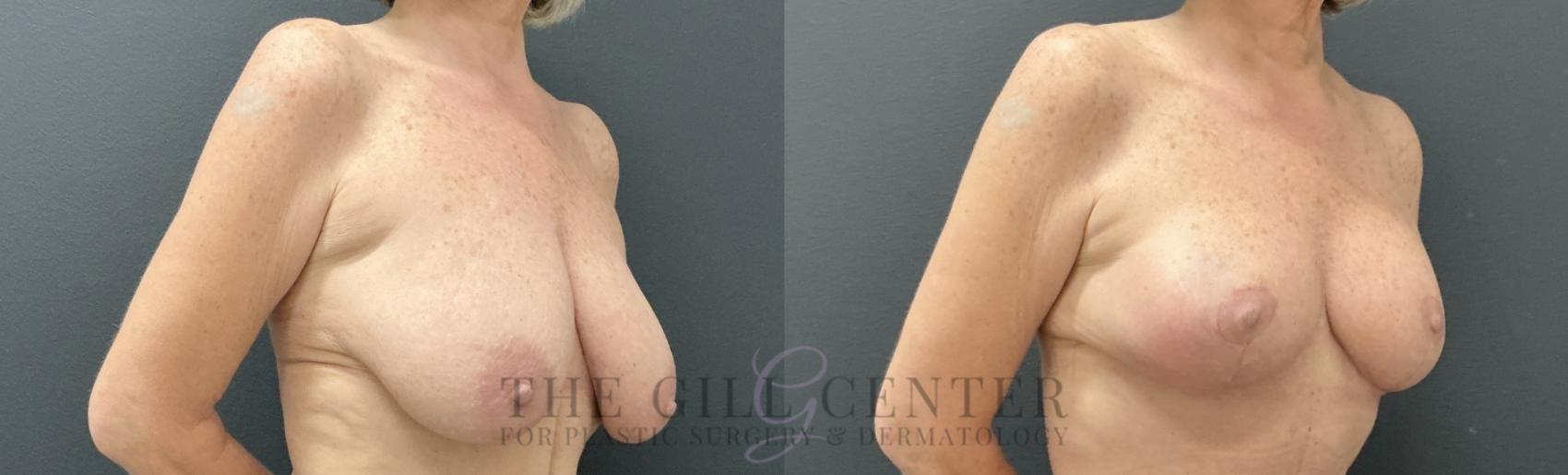 Breast Lift Case 814 Before & After Right Oblique | The Woodlands, TX | The Gill Center for Plastic Surgery and Dermatology