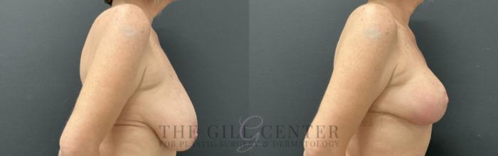 Breast Lift Case 814 Before & After Right Side | The Woodlands, TX | The Gill Center for Plastic Surgery and Dermatology