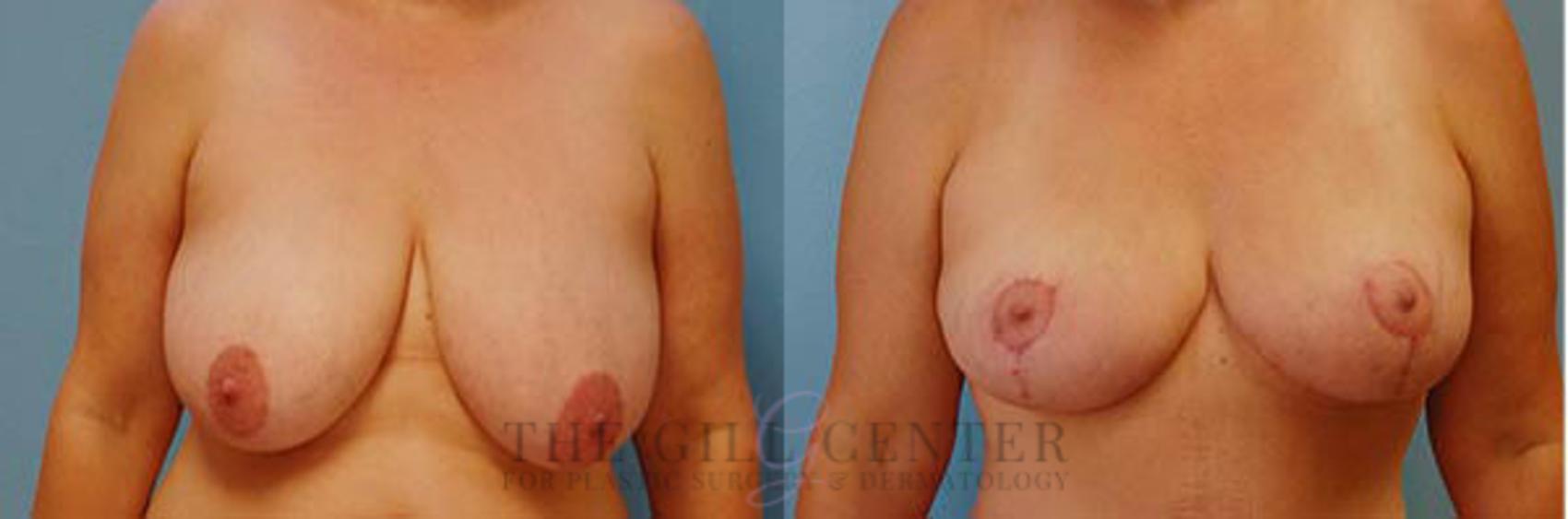 Breast Lift Case 82 Before & After Front | The Woodlands, TX | The Gill Center for Plastic Surgery and Dermatology