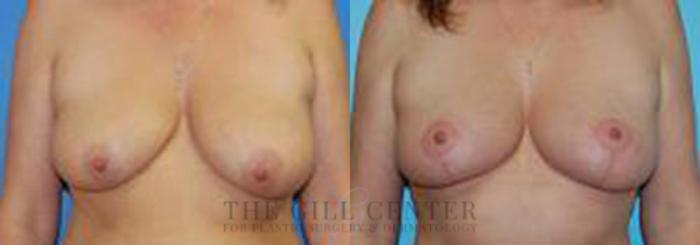 Breast Lift Case 83 Before & After Front | The Woodlands, TX | The Gill Center for Plastic Surgery and Dermatology