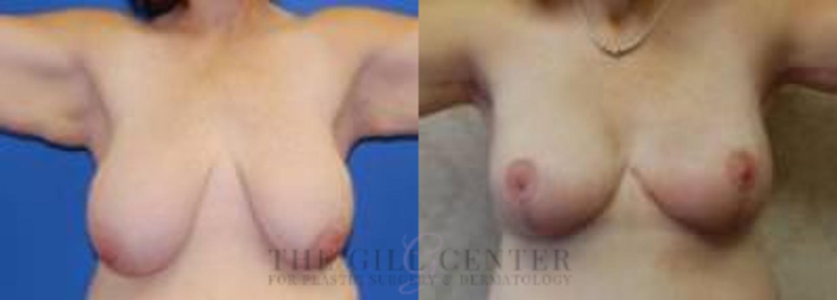Breast Lift Case 84 Before & After Front | The Woodlands, TX | The Gill Center for Plastic Surgery and Dermatology