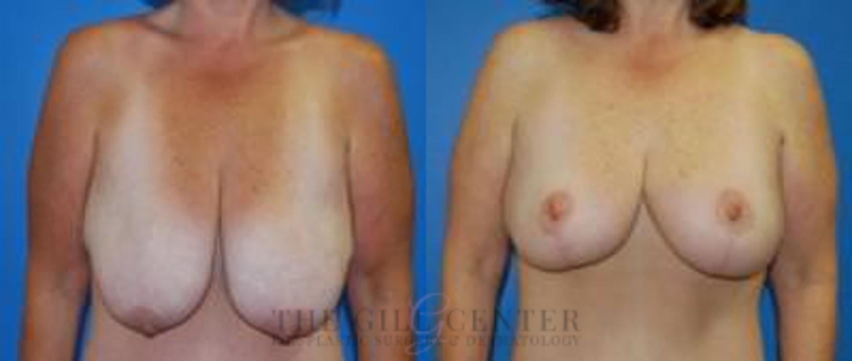 Breast Lift Case 85 Before & After Front | The Woodlands, TX | The Gill Center for Plastic Surgery and Dermatology
