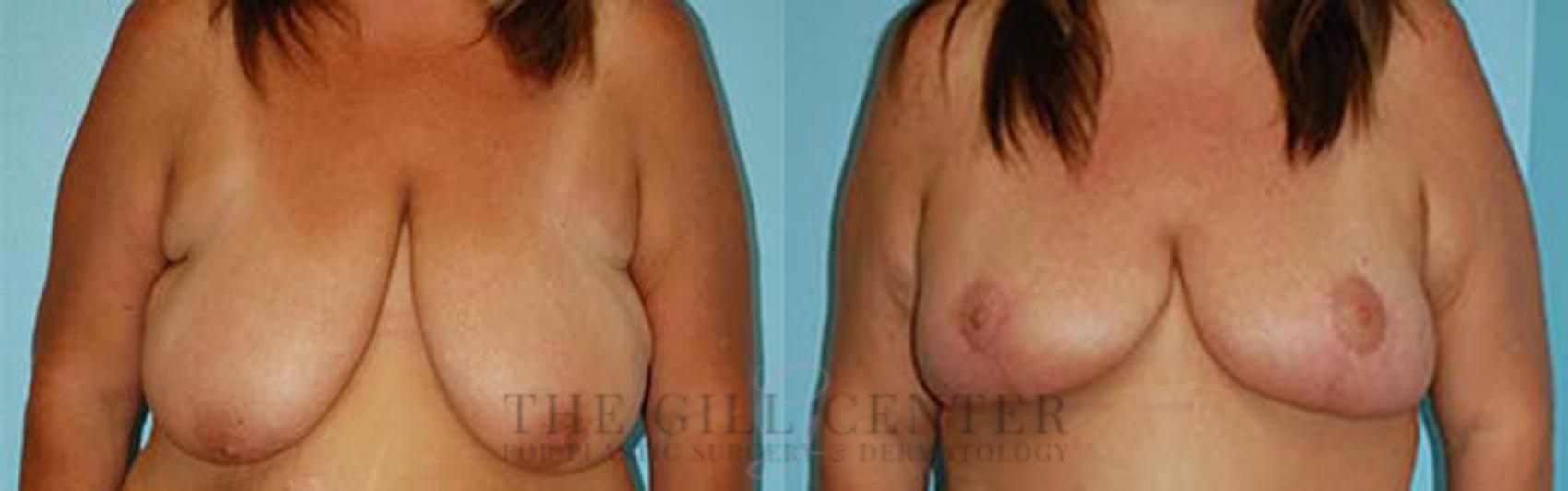 Breast Lift Case 86 Before & After Front | The Woodlands, TX | The Gill Center for Plastic Surgery and Dermatology