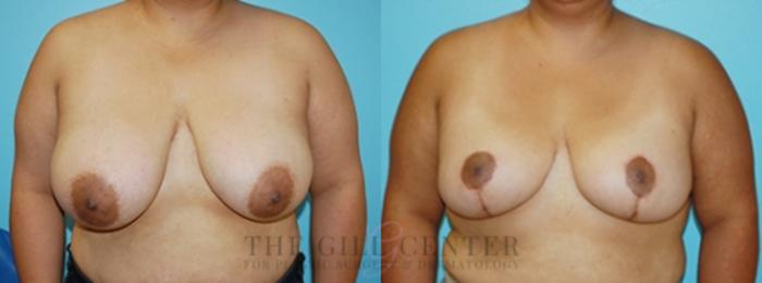 Breast Lift Case 87 Before & After Front | The Woodlands, TX | The Gill Center for Plastic Surgery and Dermatology