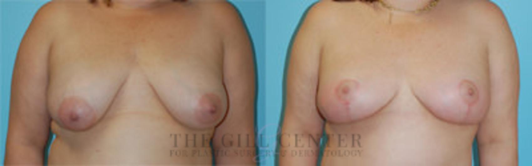 Breast Lift Case 91 Before & After Front | The Woodlands, TX | The Gill Center for Plastic Surgery and Dermatology