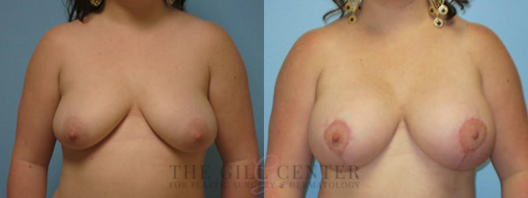 Breast Lift with Implants Case 102 Before & After Front | The Woodlands, TX | The Gill Center for Plastic Surgery and Dermatology