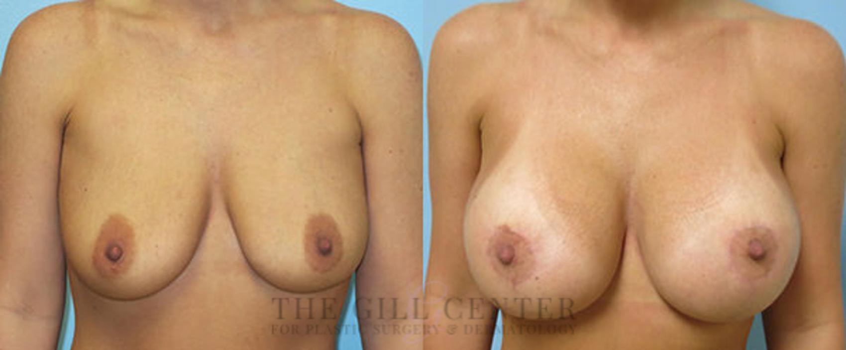 Breast Lift with Implants Case 103 Before & After Front | The Woodlands, TX | The Gill Center for Plastic Surgery and Dermatology