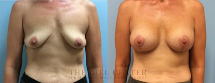 Breast Lift with Implants Case 105 Before & After Front | The Woodlands, TX | The Gill Center for Plastic Surgery and Dermatology