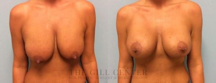 Breast Lift with Implants Case 106 Before & After Front | The Woodlands, TX | The Gill Center for Plastic Surgery and Dermatology