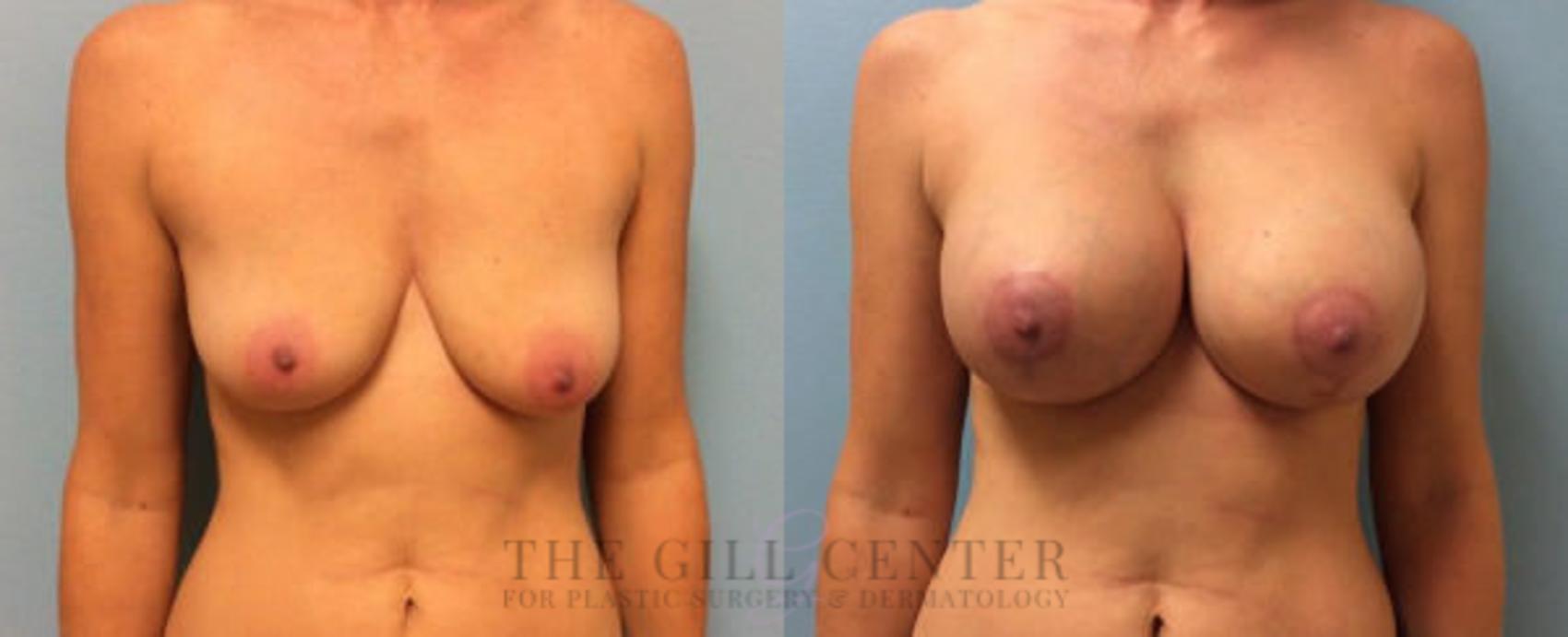 Breast Lift with Implants Case 107 Before & After Front | The Woodlands, TX | The Gill Center for Plastic Surgery and Dermatology