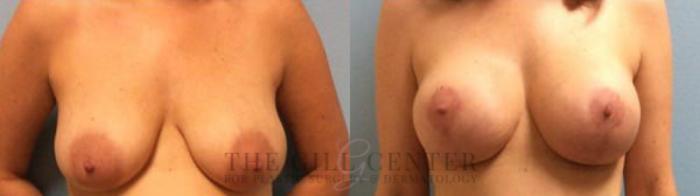 Breast Lift with Implants Case 108 Before & After Front | The Woodlands, TX | The Gill Center for Plastic Surgery and Dermatology