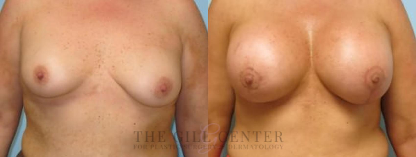 Breast Lift with Implants Case 109 Before & After Front | The Woodlands, TX | The Gill Center for Plastic Surgery and Dermatology