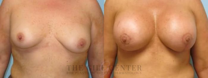 Breast Lift with Implants Case 109 Before & After Front | The Woodlands, TX | The Gill Center for Plastic Surgery and Dermatology