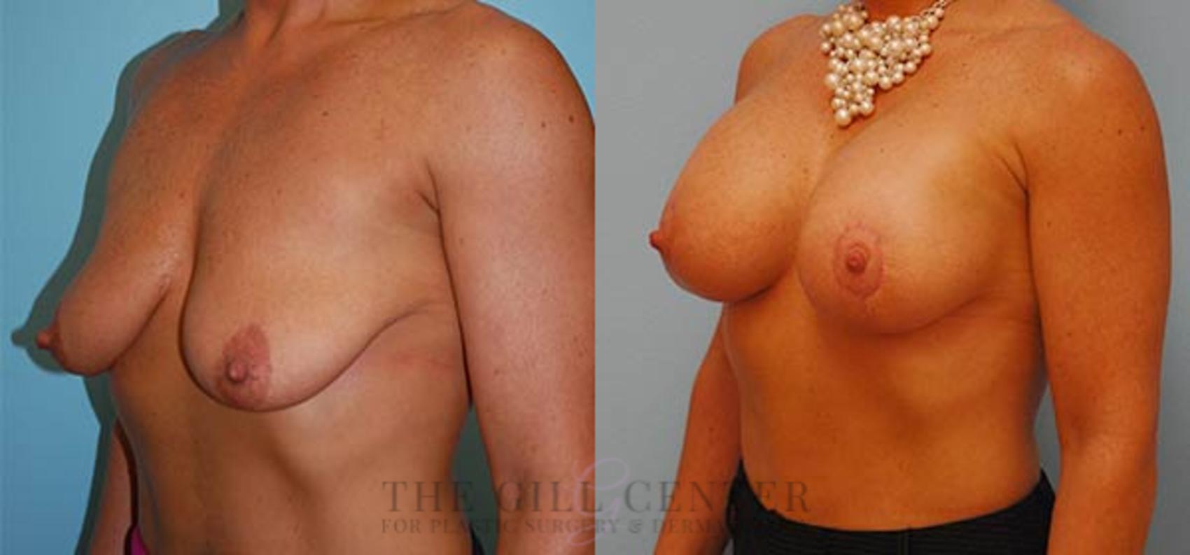 Breast Lift with Implants Case 110 Before & After Left Oblique | The Woodlands, TX | The Gill Center for Plastic Surgery and Dermatology