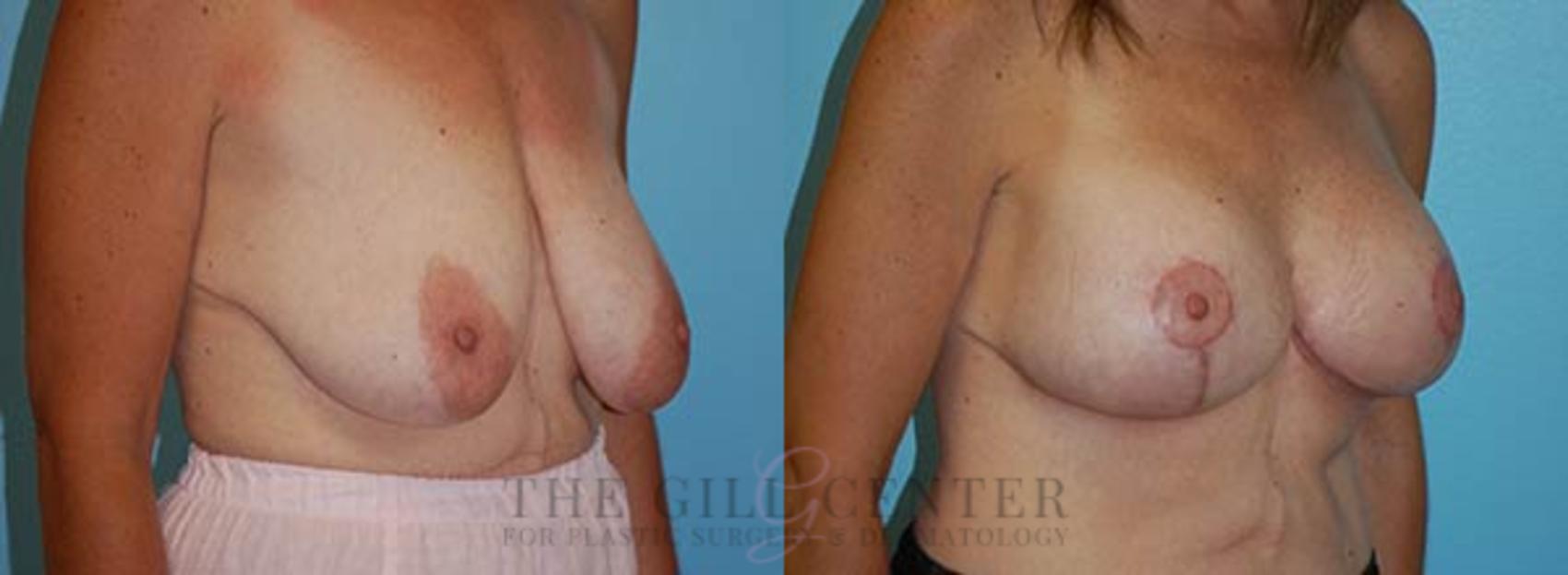 Breast Lift with Implants Case 113 Before & After Right Oblique | The Woodlands, TX | The Gill Center for Plastic Surgery and Dermatology