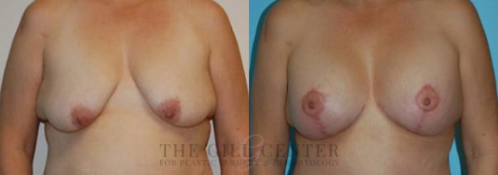 Breast Lift with Implants Case 114 Before & After Front | The Woodlands, TX | The Gill Center for Plastic Surgery and Dermatology