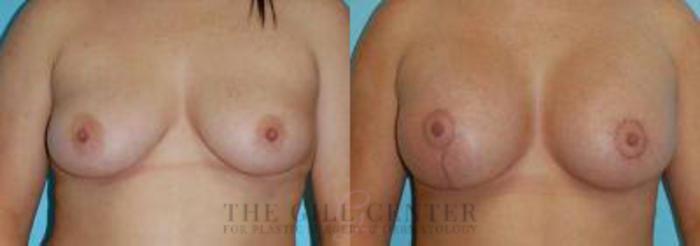 Breast Lift with Implants Case 115 Before & After Front | The Woodlands, TX | The Gill Center for Plastic Surgery and Dermatology