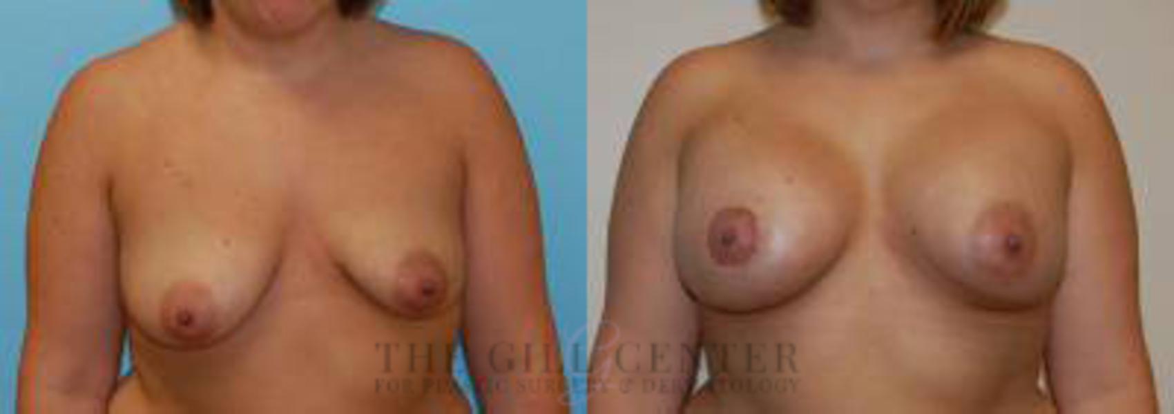 Breast Lift with Implants Case 116 Before & After Front | The Woodlands, TX | The Gill Center for Plastic Surgery and Dermatology