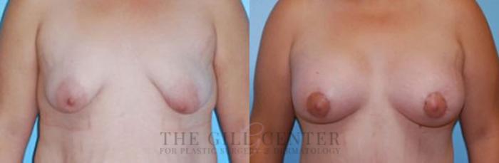 Breast Lift with Implants Case 117 Before & After Front | The Woodlands, TX | The Gill Center for Plastic Surgery and Dermatology