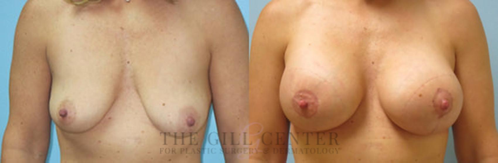 Breast Lift with Implants Case 118 Before & After Front | The Woodlands, TX | The Gill Center for Plastic Surgery and Dermatology